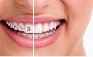 Wilckodontics – Periodontally Accelerated Osteogenic Orthodontics